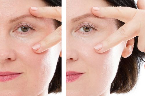 how to lift nasolabial folds